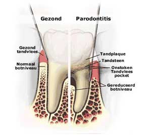 paradontitis